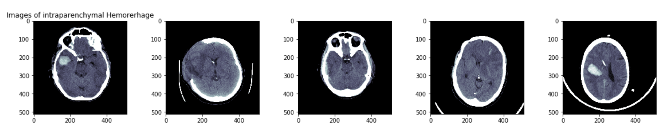 intracranial hemorrhage.png