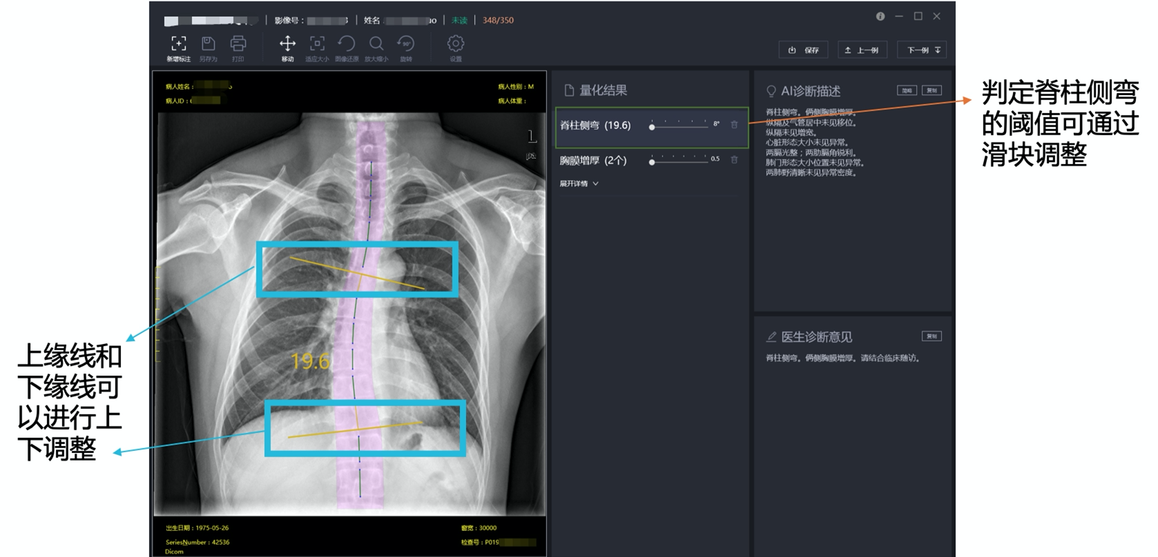 脊柱侧弯结果展示